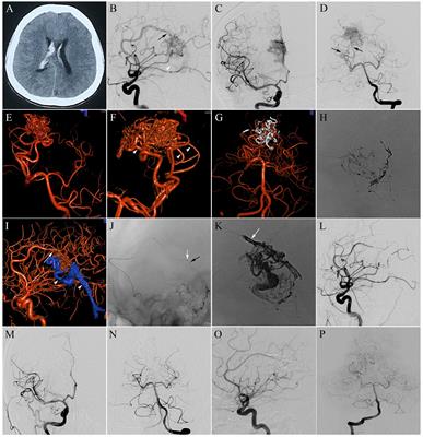 Application of the pressure cooker technique for transarterial embolization of brain arteriovenous malformations: Factors affecting obliteration and outcomes